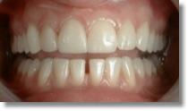 Lasers Porcelain Veneers Dr.Saldivar