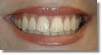 Gum Reshaping Dr.Javier Saldivar