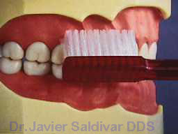 Tecnica De Leonard